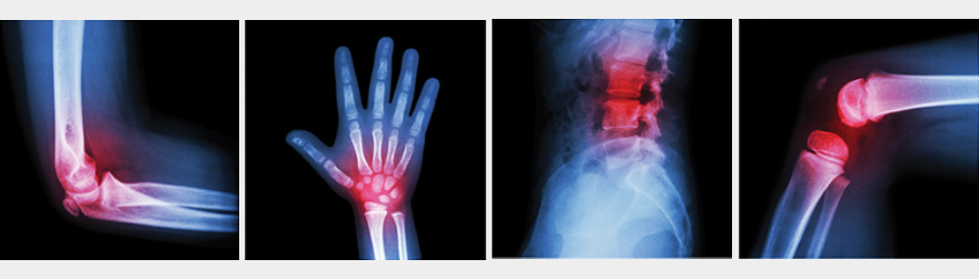 Artrita degenerativa - Osteoartrita