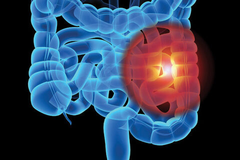 Calprotectin and Mucosal Healing